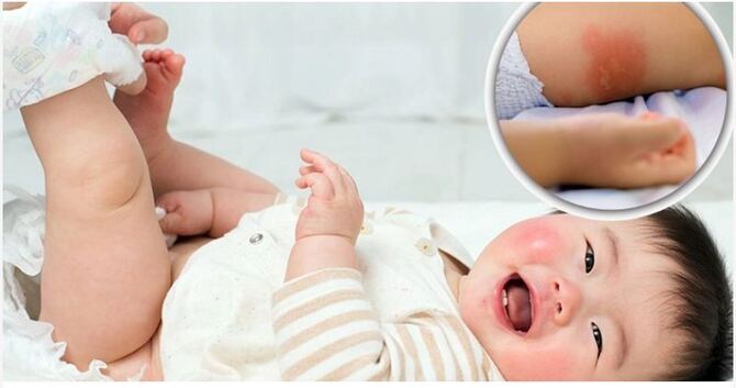 ডায়াপার ব্যবহারে শিশুর ফুসকুড়ি হলে করণীয়