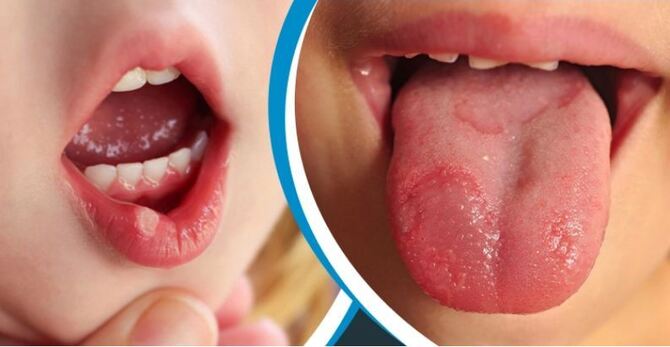 শিশুর মুখের ঘা দূর করতে যা করবেন