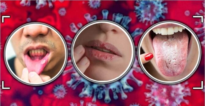 মুখের যেসব সমস্যায় বুঝবেন আপনি করোনায় আক্রান্ত