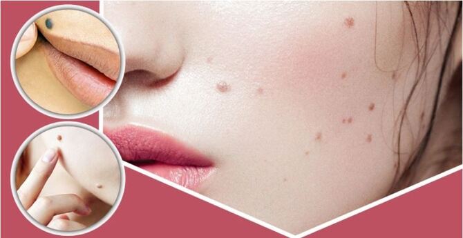 ত্বকের অবাঞ্ছিত আঁচিল দূর করার ঘরোয়া উপায়