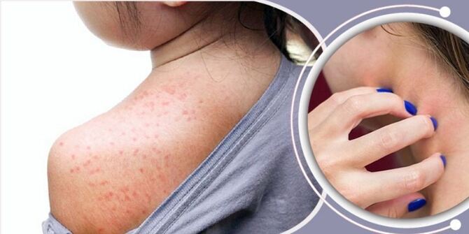 এই সময়ে ঘামাচি থেকে মুক্তির ঘরোয়া উপায়