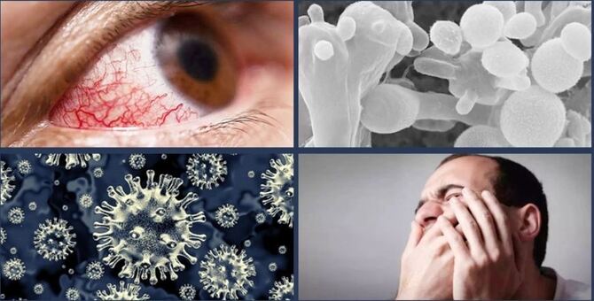 ব্ল্যাক ও হোয়াইট ফাঙ্গাসের লক্ষণ কী? কারা আছেন ঝুঁকিতে?