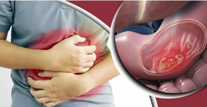 অতিরিক্ত গ্যাস্ট্রিকের সমস্যা, ক্যান্সারের লক্ষণ নয় তো?