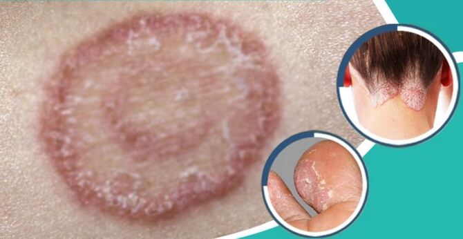 বর্ষায় দাদ-অ্যাকজিমাসহ বিভিন্ন চর্মরোগ থেকে বাঁচার উপায়