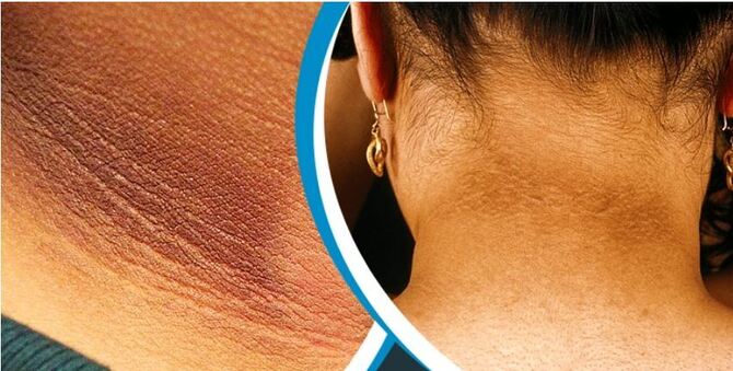 ঘাড় ও গলার কালো দাগ দূর করার ৫ উপায়