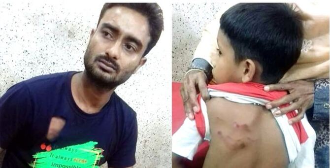 কুমিল্লায় কুকুরের কামড়ে শিশুসহ আহত ২৪