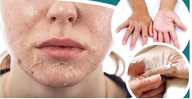 ত্বকের চামড়া ওঠার সমস্যা সমাধানের উপায়