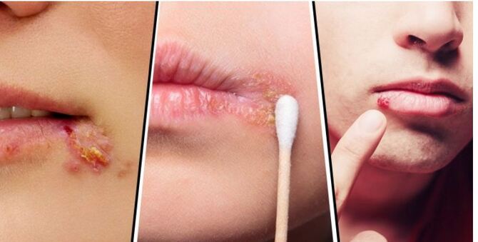 জ্বরঠোসার ব্যথা ও ঘা দ্রুত সারাবেন যেভাবে