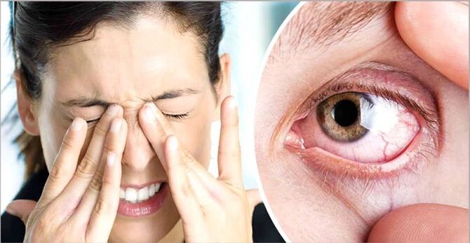 চোখের জ্বালাপোড়া ও ব্যথা কমানোর ৫ উপায়