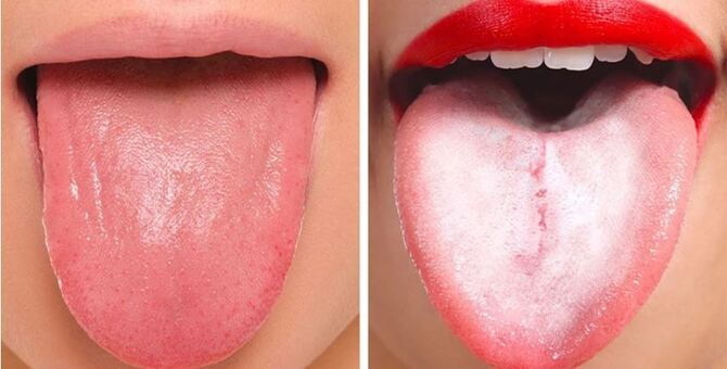 জিহ্বার রং দেখেই বুঝে নিন আপনি কতটা সুস্থ