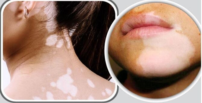 ছুলির সমস্যা থেকে মুক্তি মিলবে ৬ উপায়ে