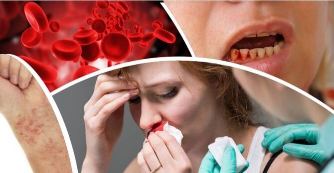 প্লাটিলেট কমে যায় কেন, এর লক্ষণ কী?