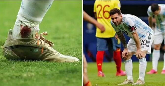 পা থেকে গড়িয়ে পড়ছে রক্ত, তবুও খেলে গেলেন মেসি