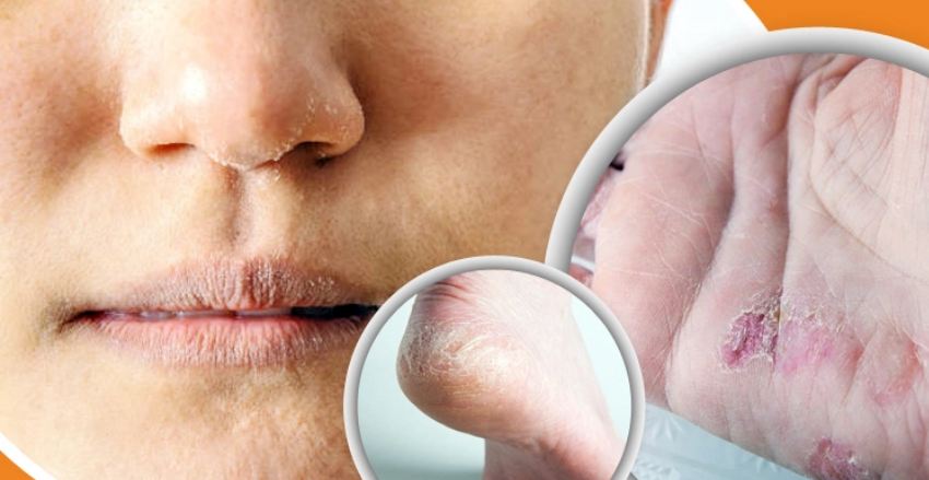 শীতে ত্বক ও পা ফাটা রোধে এখনই যা করবেন